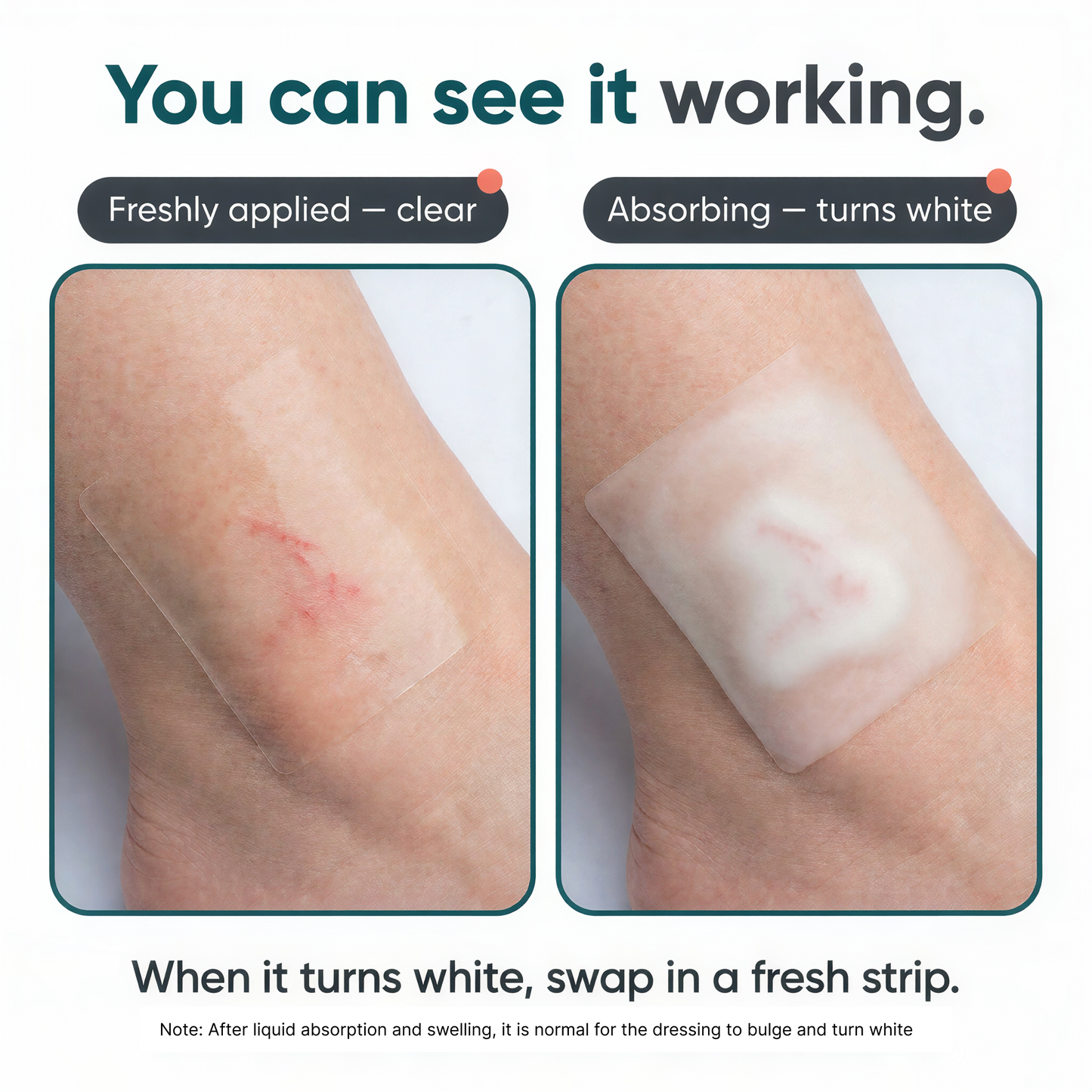 Hot-Spot Hydrocolloid Tape